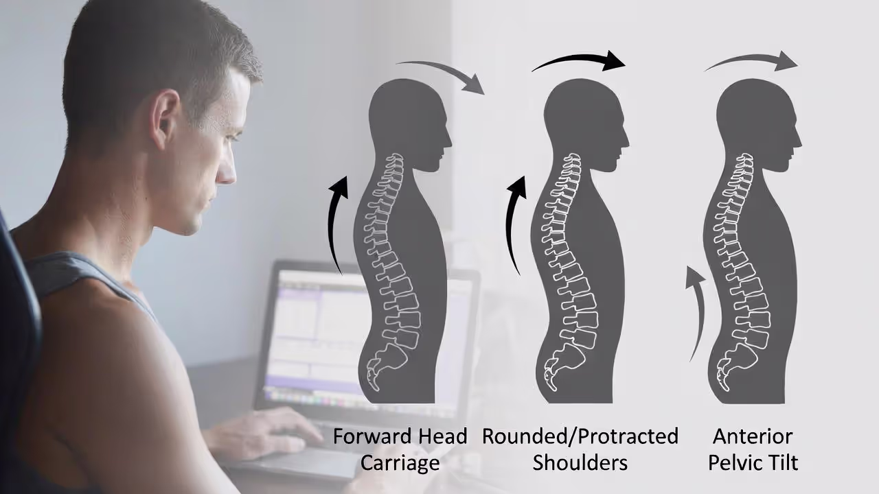 Infographic showing forward head posture, rounded shoulders, and anterior pelvic tilt with labeled arrows.